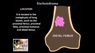 Orthopedic Oncology Course  Introduction to Musculoskeletal Tumors  Lecture 1 [upl. by Gawlas]