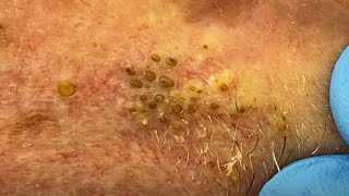 Extreme Blackhead Extraction Summer Throwback  CONTOUR DERMATOLOGY [upl. by Nirrek]