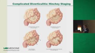 Diverticulitis and Ways to Prevent Having Another Flare Up PLUS What I Personally Use [upl. by Eked327]