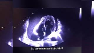 Massive Pericardial Effusion  This is how electrical alternans produced on ECG [upl. by Rowen]