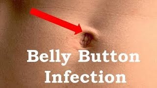 How To Treat Belly Button Infection [upl. by Bryanty40]