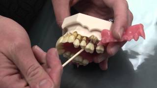 What is Periodontal Disease [upl. by Joly]