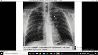 TD 06 pneumologie  syndrome interstitiel [upl. by Akcimat]