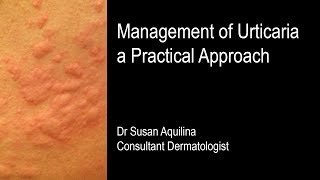 Management of Urticaria a Practical Approach [upl. by Oicnecserc182]