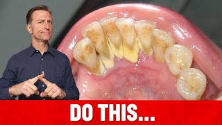 The 1 Top Remedy for Dental Plaque TARTAR [upl. by Eenel460]