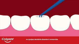 Tratamento de Canal Radicular  Colgate® [upl. by Strepphon791]