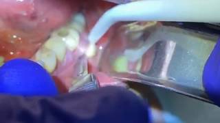 Draining a Dental Abscess  Advanced Dental Care [upl. by Animahs611]