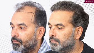 Best Hair Transplant Results from Day 1 to Month 10 [upl. by Hsetih18]