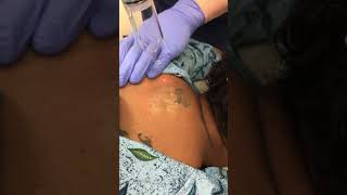 PiQo4 Advanced Laser Tattoo Removal [upl. by Jennilee]