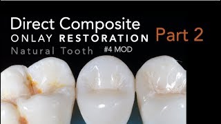 How to Make a Quick Provisional Temporary Restoration [upl. by Frost]