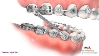 Orthodontic Treatment for Overjet Overbite  Forsus Appliance [upl. by Aidualc]