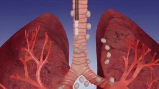 EBUS Procedure OverviewOlympus Bronchoscopy [upl. by Sokin193]