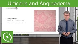 Urticaria Hives and Angioedema – Pediatrics  Lecturio [upl. by Notserk]