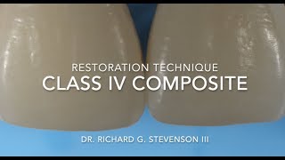 Class IV Composite Restoration  Restoration Technique [upl. by Mckale678]