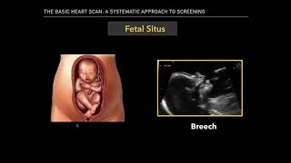 The Basic Fetal Heart Scan [upl. by Cida]