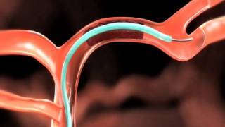 Revascularization  Regenerative Endodontic Procedure [upl. by Leasa]