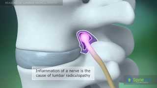 Lumbar Radiculopathy Reasons [upl. by Kalagher]