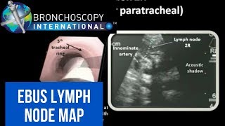 Nasotracheal suctioning NTS  3D animation [upl. by Leksehc]