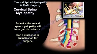 Cervical Spine Myelopathy amp Radiculopathy  Everything You Need To Know  Dr Nabil Ebraheim [upl. by Kcirdorb]