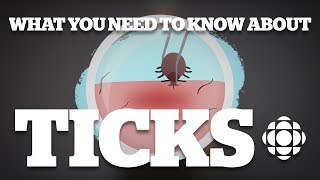 What you need to know about ticks [upl. by Artimed]