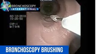 Flexible Bronchoscopy Basic Techniques 5  Brushing [upl. by Yehudit]