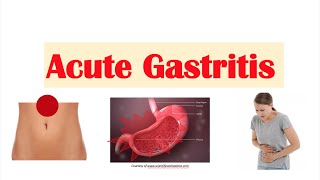 Acute Gastritis Stomach Inflammation  Causes Signs amp Symptoms Diagnosis Treatment [upl. by Drofnas]