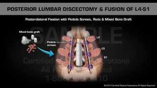 Posterior Lumbar Discectomy amp Fusion of L4S1 [upl. by Alfeus104]