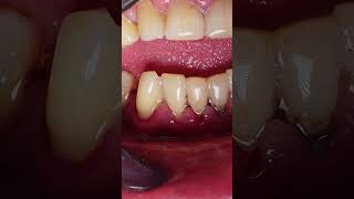 Satisfying TARTAR REMOVAL and CLEANING video [upl. by Ronel]