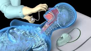 Difficult Intubation Cautious Extubation from AOD [upl. by Retrak559]