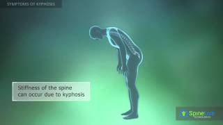 Kyphosis Symptoms [upl. by Odelia]