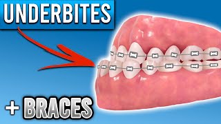 How Do Braces Fix Underbites  Premier Orthodontics [upl. by Caravette114]