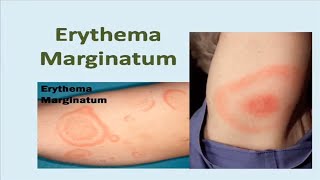 Erythema Marginatum Rash [upl. by Chip498]