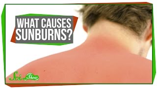 What Causes Sunburns [upl. by Iznyl]