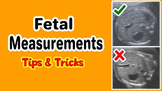 Fetal Measurements Tips and Tricks [upl. by Eninnaj]