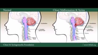 Chiari Malformation amp Syringomyelia [upl. by Rosmunda]