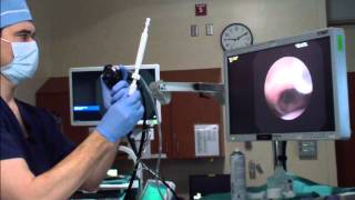 Bronchoscope assembly guide [upl. by Dorothi]