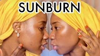 Sunburn Treatment For Black Skin  How To Clear Sunburn Fast [upl. by Ardie]