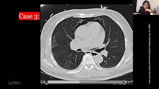 Approach to CT scan of the Acute Abdomen [upl. by Ahsenik583]