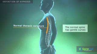 Kyphosis Definition [upl. by Lessig]