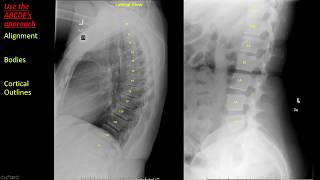 Introduction to Spine Radiographs [upl. by Nedlog]