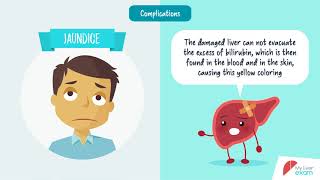 LIVER CIRRHOSIS causespathophysiologyfeaturesdiagnosistreatment [upl. by Eniala957]