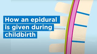 How an epidural is given during childbirth  Bupa Health [upl. by Garmaise]