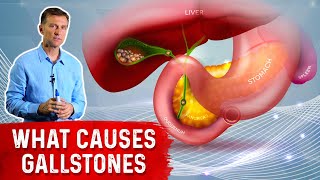 What Really Causes Gallstones  Dr Berg [upl. by Elin]