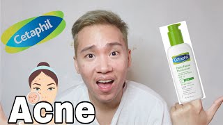 Cetaphil Daily Facial Moisturizer SPF 15 Review for Acne prone skin [upl. by Samau203]