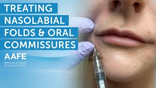 Using Dermal Fillers to Fill and Smooth Smile Lines  AAFE [upl. by Meriel]