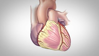 Solitaire™ FR Revascularization Device [upl. by Sucramel]