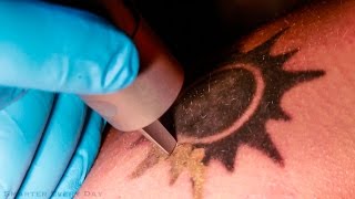 How Laser Tattoo Removal Works  Smarter Every Day 123 [upl. by Trudy159]