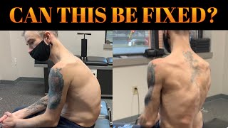 SEVERE Scoliosis  Kyphosis amp Chiropractic Former Power Lifter Suffers Career Ending Injury [upl. by Huberty]