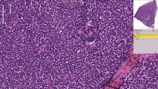 Nephroblastoma  Kidney Histopathology [upl. by Cathee]