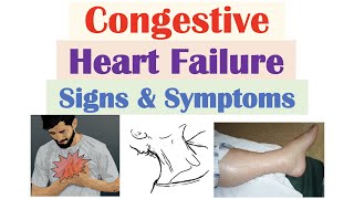 Heart Failure Symptoms and Treatments [upl. by Lednyk691]